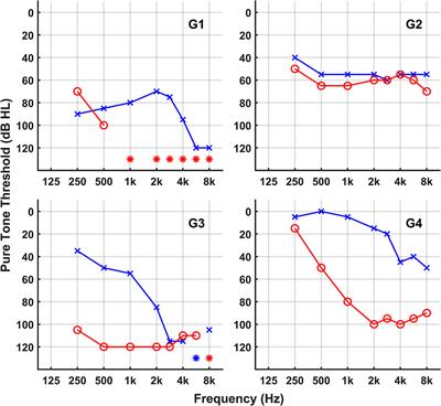 Responsiveness of the electrically stimulated cochlear nerve in patients with a missense variant in ACTG1: preliminary results